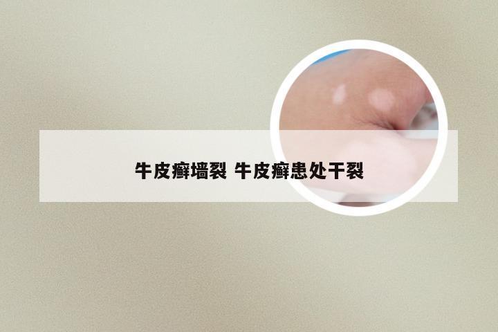 牛皮癣墙裂 牛皮癣患处干裂