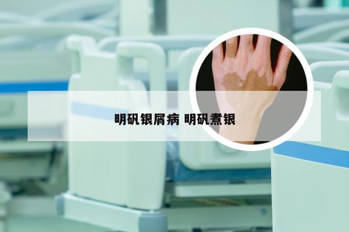 明矾银屑病 明矾煮银