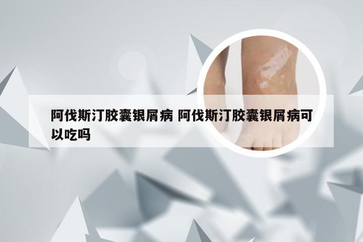 阿伐斯汀胶囊银屑病 阿伐斯汀胶囊银屑病可以吃吗