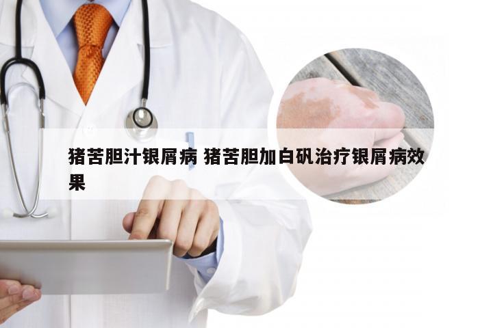 猪苦胆汁银屑病 猪苦胆加白矾治疗银屑病效果