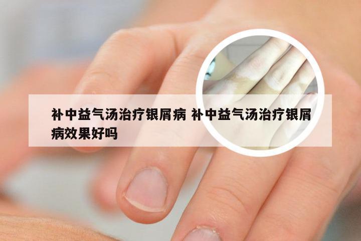 补中益气汤治疗银屑病 补中益气汤治疗银屑病效果好吗