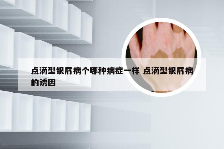 点滴型银屑病个哪种病症一样 点滴型银屑病的诱因