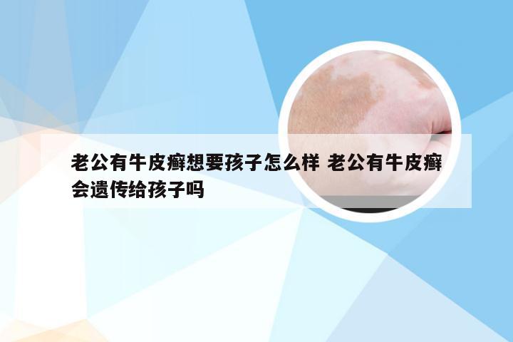 老公有牛皮癣想要孩子怎么样 老公有牛皮癣会遗传给孩子吗