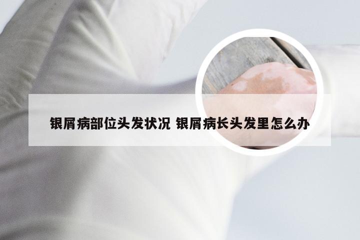 银屑病部位头发状况 银屑病长头发里怎么办