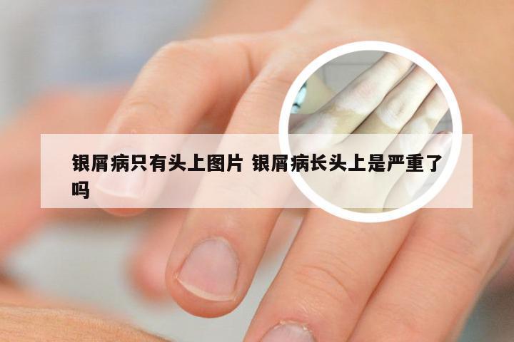 银屑病只有头上图片 银屑病长头上是严重了吗