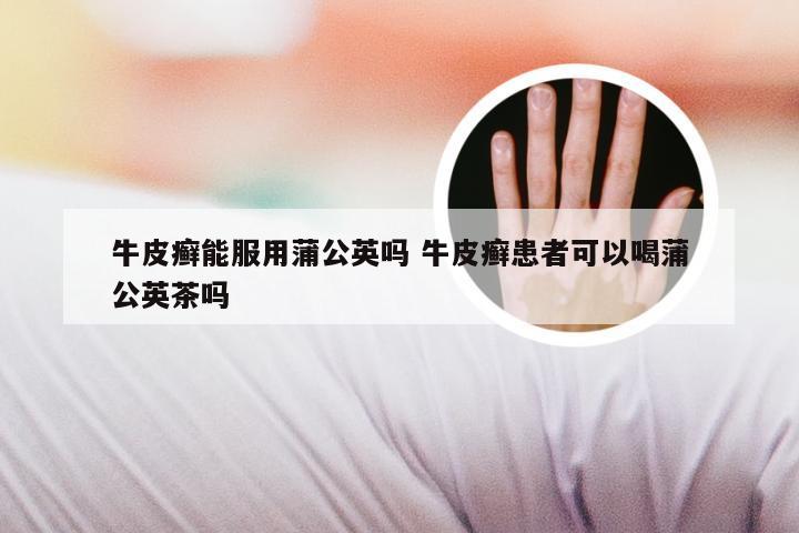 牛皮癣能服用蒲公英吗 牛皮癣患者可以喝蒲公英茶吗