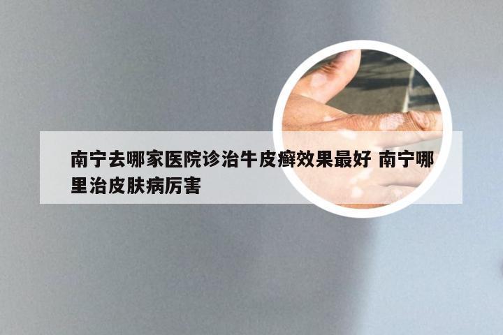 南宁去哪家医院诊治牛皮癣效果最好 南宁哪里治皮肤病厉害