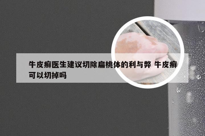 牛皮癣医生建议切除扁桃体的利与弊 牛皮癣可以切掉吗