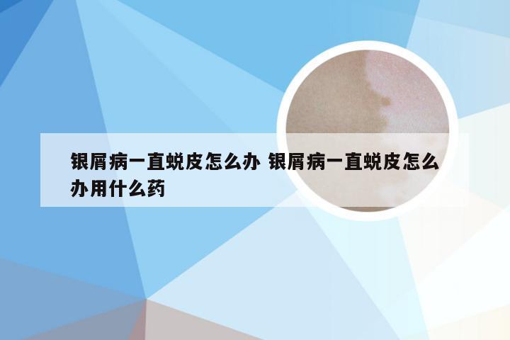 银屑病一直蜕皮怎么办 银屑病一直蜕皮怎么办用什么药