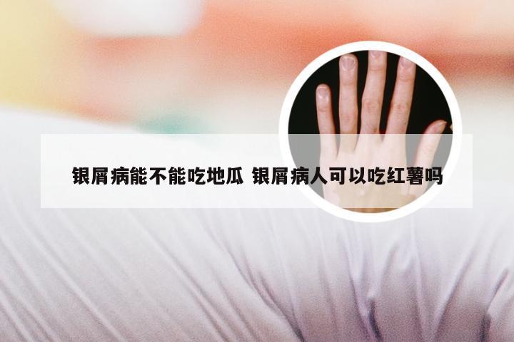 银屑病能不能吃地瓜 银屑病人可以吃红薯吗