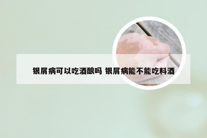 银屑病可以吃酒酿吗 银屑病能不能吃料酒