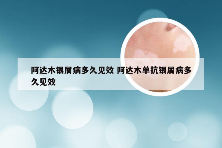 阿达木银屑病多久见效 阿达木单抗银屑病多久见效