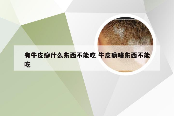 有牛皮癣什么东西不能吃 牛皮癣啥东西不能吃