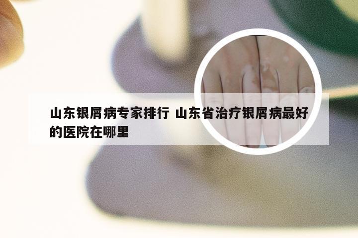 山东银屑病专家排行 山东省治疗银屑病最好的医院在哪里