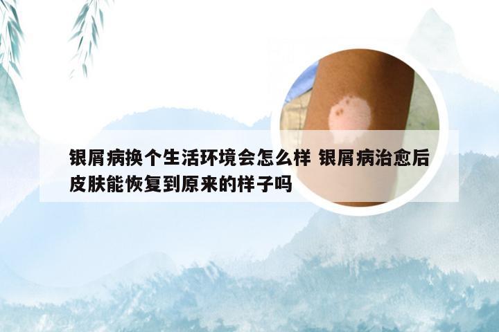 银屑病换个生活环境会怎么样 银屑病治愈后皮肤能恢复到原来的样子吗