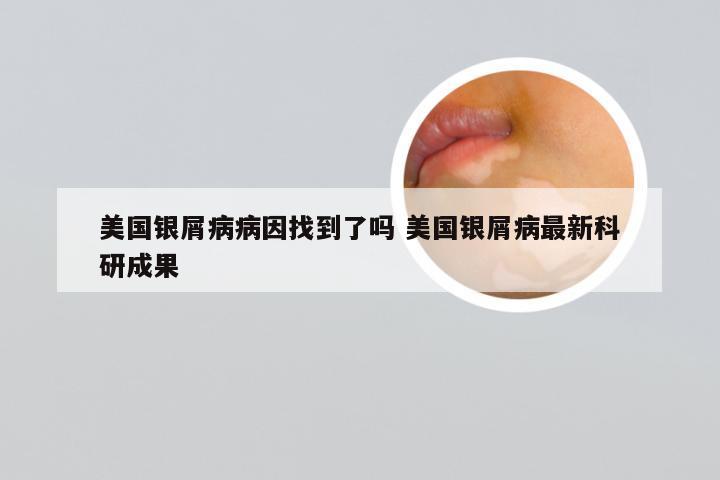 美国银屑病病因找到了吗 美国银屑病最新科研成果
