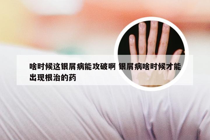 啥时候这银屑病能攻破啊 银屑病啥时候才能出现根治的药