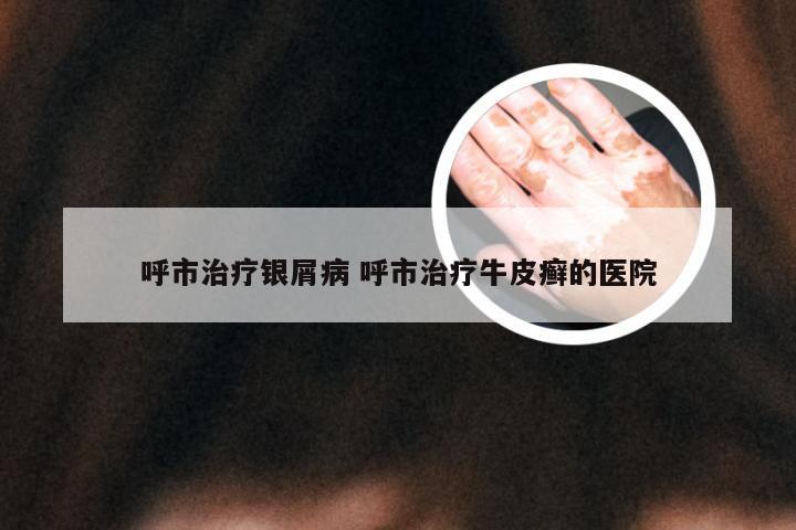 呼市治疗银屑病 呼市治疗牛皮癣的医院