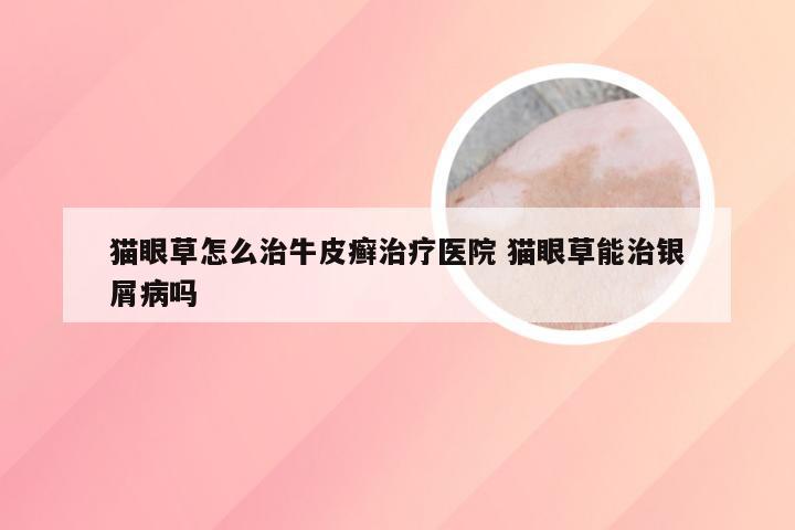 猫眼草怎么治牛皮癣治疗医院 猫眼草能治银屑病吗