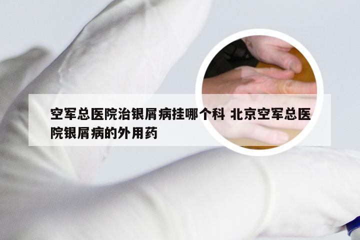 空军总医院治银屑病挂哪个科 北京空军总医院银屑病的外用药