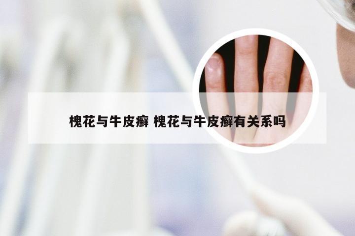 槐花与牛皮癣 槐花与牛皮癣有关系吗