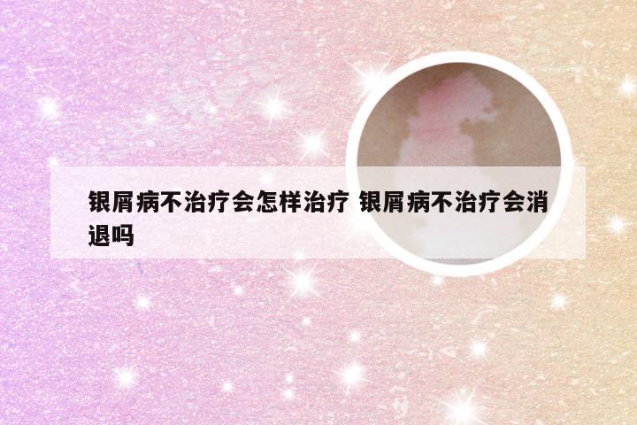 银屑病不治疗会怎样治疗 银屑病不治疗会消退吗
