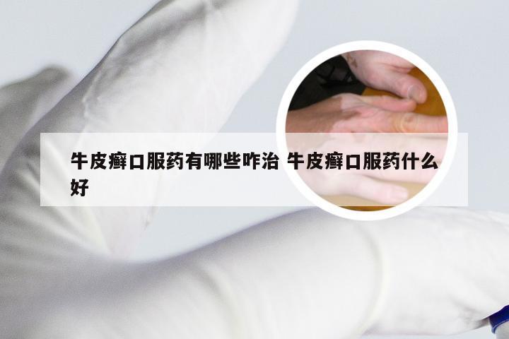 牛皮癣口服药有哪些咋治 牛皮癣口服药什么好