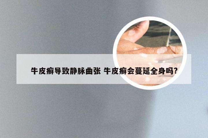 牛皮癣导致静脉曲张 牛皮癣会蔓延全身吗?