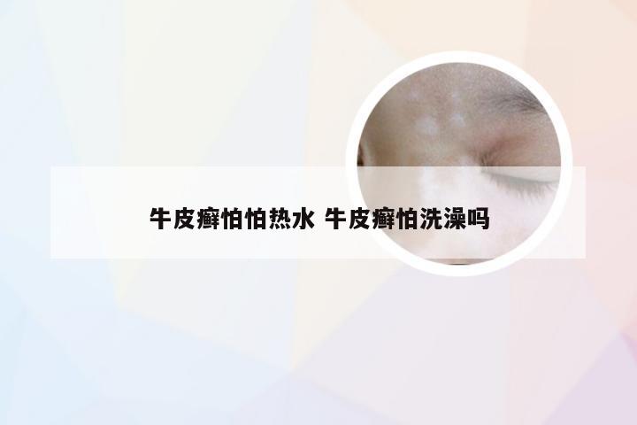 牛皮癣怕怕热水 牛皮癣怕洗澡吗