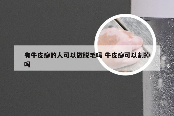 有牛皮癣的人可以做脱毛吗 牛皮癣可以割掉吗