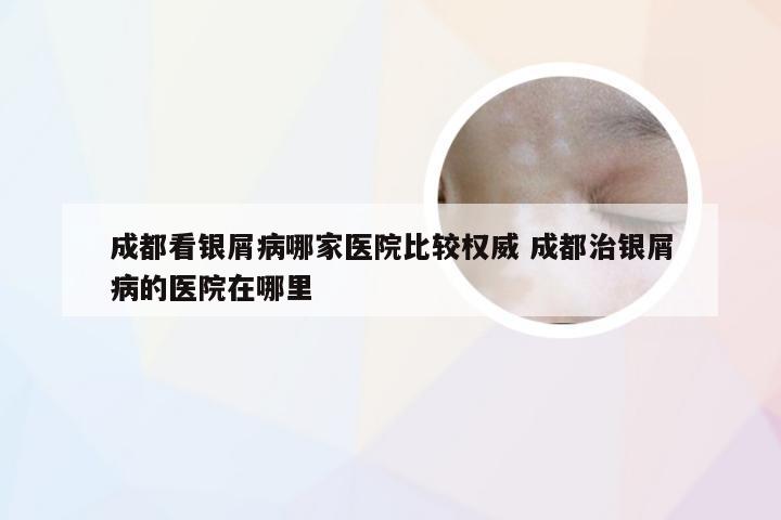 成都看银屑病哪家医院比较权威 成都治银屑病的医院在哪里