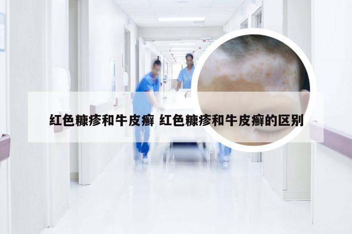 红色糠疹和牛皮癣 红色糠疹和牛皮癣的区别
