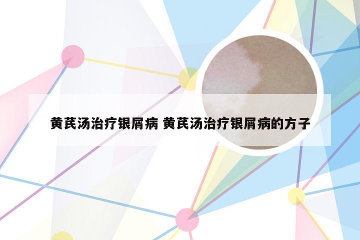 黄芪汤治疗银屑病 黄芪汤治疗银屑病的方子