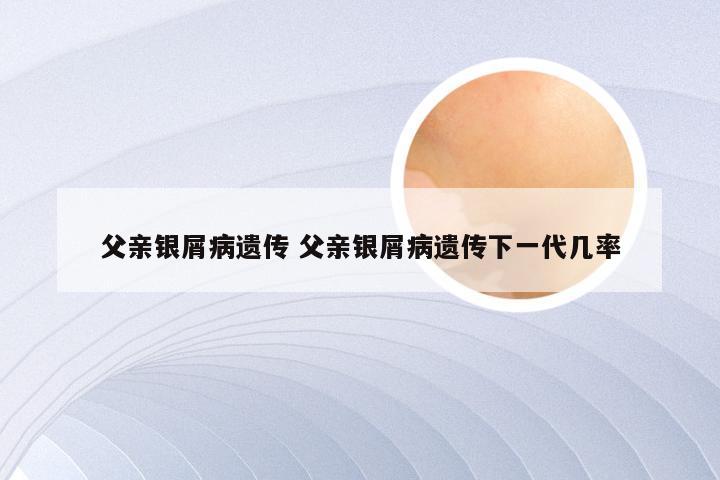 父亲银屑病遗传 父亲银屑病遗传下一代几率