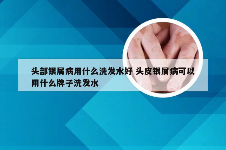 头部银屑病用什么洗发水好 头皮银屑病可以用什么牌子洗发水