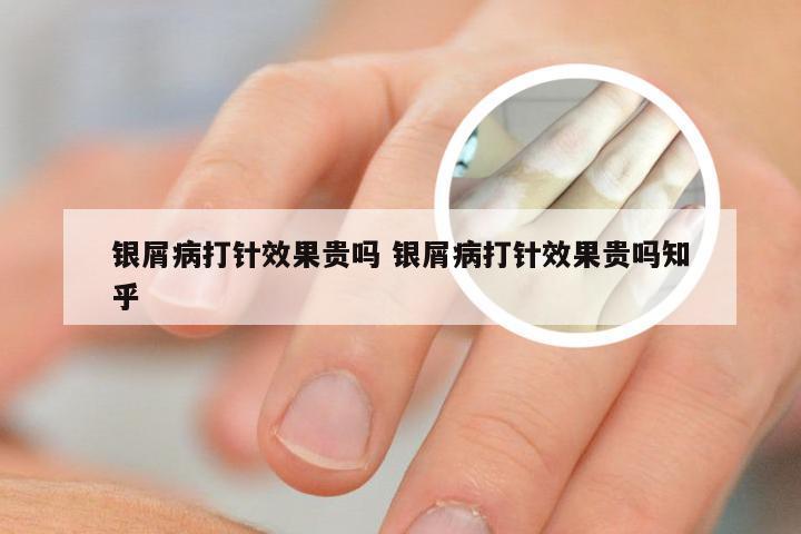 银屑病打针效果贵吗 银屑病打针效果贵吗知乎