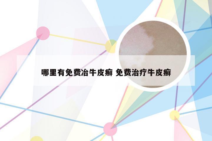 哪里有免费冶牛皮癣 免费治疗牛皮癣