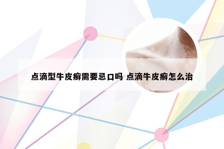 点滴型牛皮癣需要忌口吗 点滴牛皮癣怎么治
