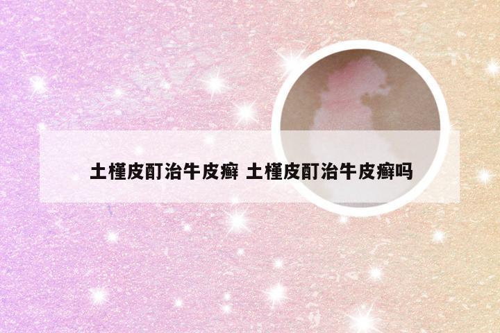 土槿皮酊治牛皮癣 土槿皮酊治牛皮癣吗