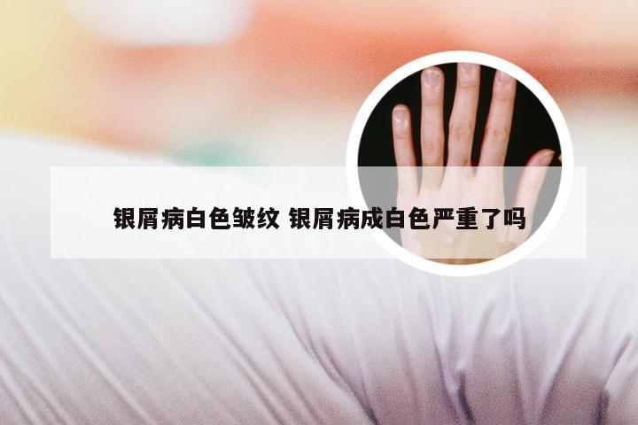 银屑病白色皱纹 银屑病成白色严重了吗