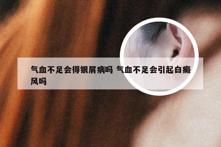 气血不足会得银屑病吗 气血不足会引起白癜风吗
