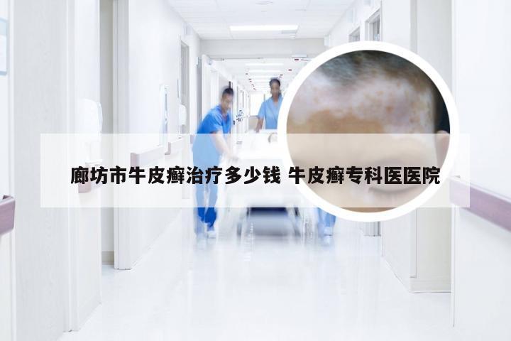 廊坊市牛皮癣治疗多少钱 牛皮癣专科医医院