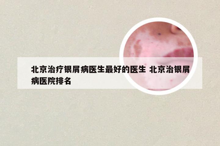 北京治疗银屑病医生最好的医生 北京治银屑病医院排名