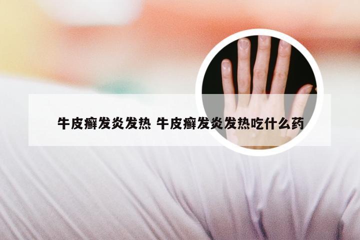 牛皮癣发炎发热 牛皮癣发炎发热吃什么药