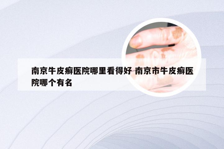 南京牛皮癣医院哪里看得好 南京市牛皮癣医院哪个有名