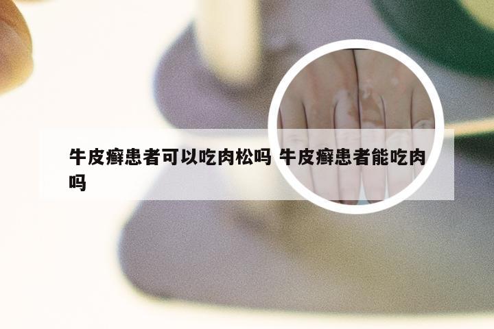 牛皮癣患者可以吃肉松吗 牛皮癣患者能吃肉吗
