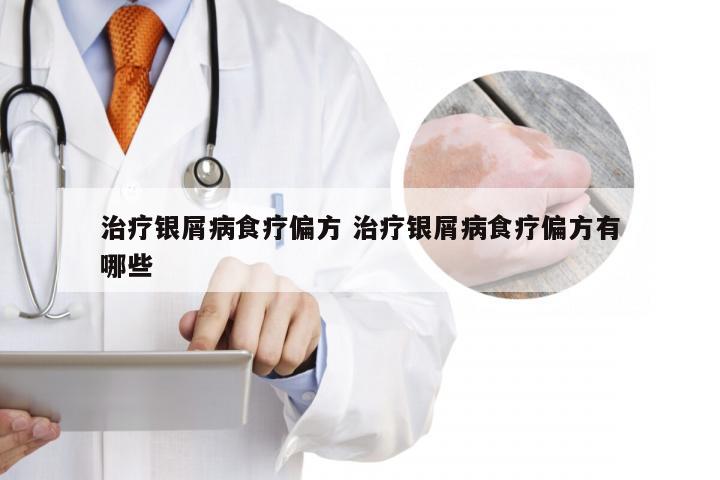 治疗银屑病食疗偏方 治疗银屑病食疗偏方有哪些