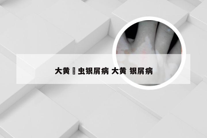 大黄蟅虫银屑病 大黄 银屑病