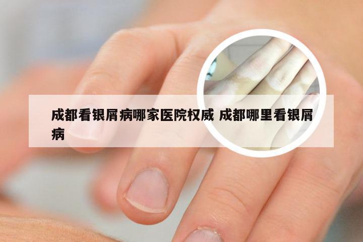 成都看银屑病哪家医院权威 成都哪里看银屑病