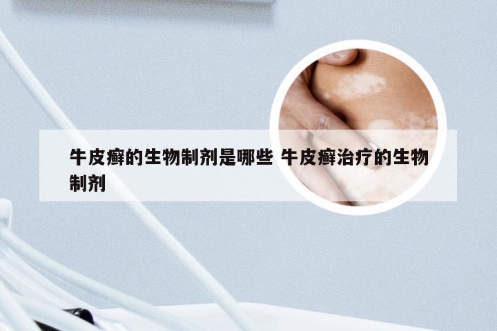 牛皮癣的生物制剂是哪些 牛皮癣治疗的生物制剂